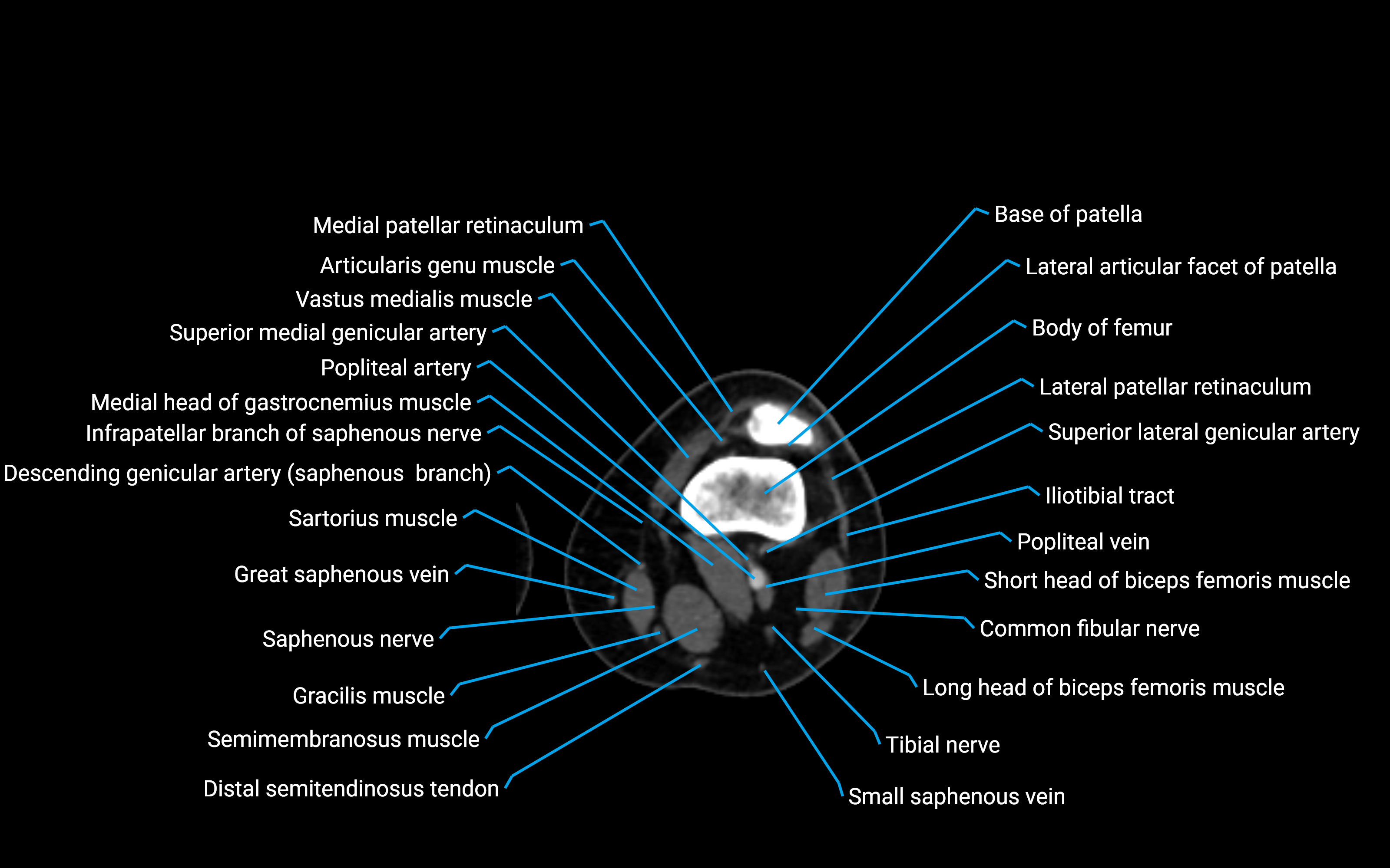 CT Lower leg axial cross sectional anatomy labelled image 80 (2).png
